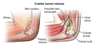 Cubital Tunnel Syndrome - Hình ảnh minh họa